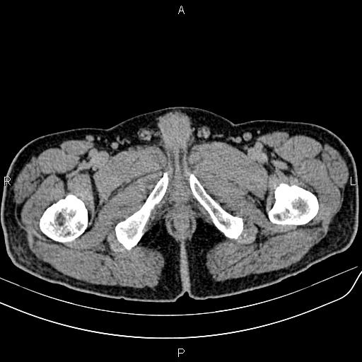 File:Cecal cancer with appendiceal mucocele (Radiopaedia 91080-108651 Axial C+ delayed 93).jpg