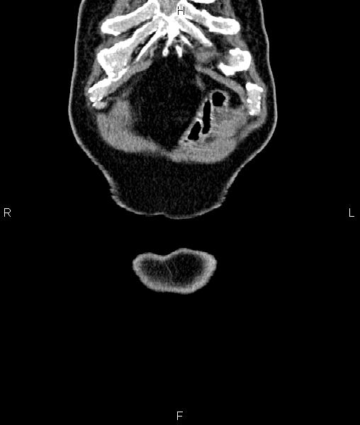 Cecal cancer with appendiceal mucocele (Radiopaedia 91080-108651 D 2).jpg