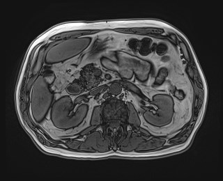 Cecal mass causing appendicitis (Radiopaedia 59207-66532 D 55).jpg