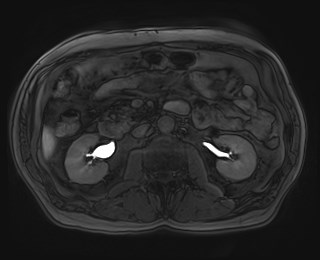 Cecal mass causing appendicitis (Radiopaedia 59207-66532 K 61).jpg