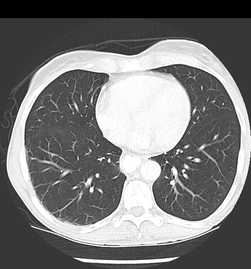 File:Cecal volvulus (Radiopaedia 48543-53513 Axial lung window 4).jpg