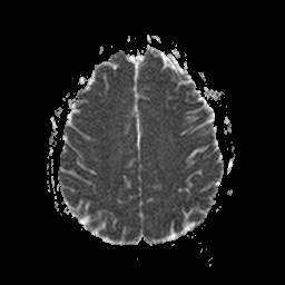 File:Central-variant posterior reversible encephalopathy syndrome (PRES) (Radiopaedia 43880-47358 Axial ADC 16).jpg
