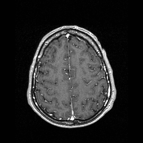Central-variant posterior reversible encephalopathy syndrome (PRES) (Radiopaedia 43880-47358 Axial T1 C+ 133).jpg