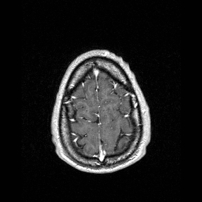 Central-variant posterior reversible encephalopathy syndrome (PRES) (Radiopaedia 43880-47358 Axial T1 C+ 153).jpg