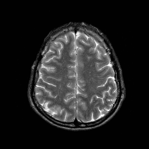 File:Central-variant posterior reversible encephalopathy syndrome (PRES) (Radiopaedia 43880-47359 Axial T2 18).jpg