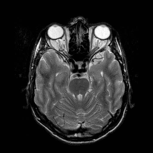 File:Central-variant posterior reversible encephalopathy syndrome (PRES) (Radiopaedia 43880-47359 Axial T2 7).jpg