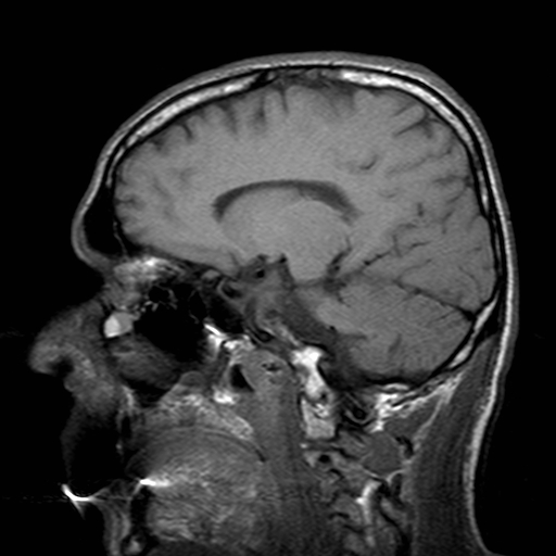 File:Central-variant posterior reversible encephalopathy syndrome (PRES) (Radiopaedia 43880-47359 Sagittal T1 9).jpg