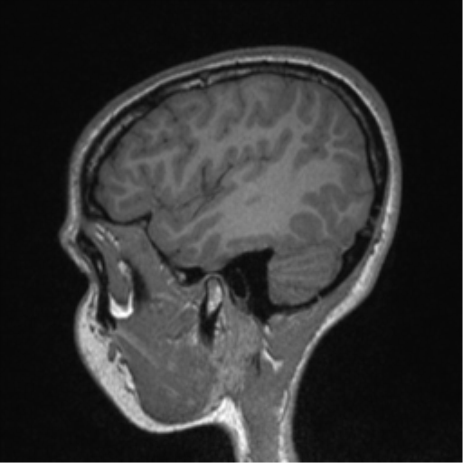 File:Central neurocytoma (Radiopaedia 37664-39557 Sagittal T1 21).png