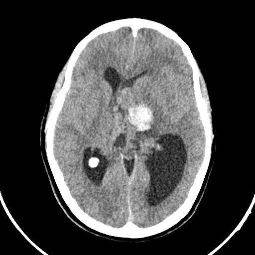 File:Central neurocytoma (Radiopaedia 84497-99871 Axial non-contrast 24).jpg