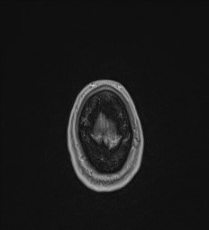 File:Central neurocytoma (Radiopaedia 84497-99872 Axial T1 C+ 145).jpg