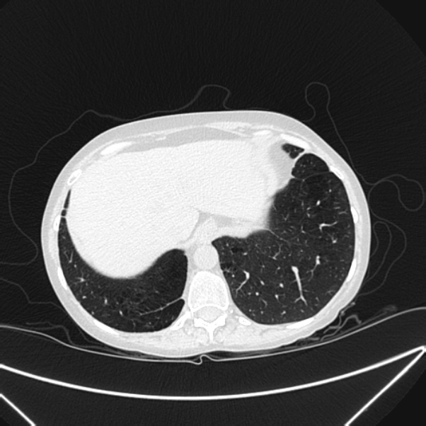 Centrilobular pulmonary emphysema (Radiopaedia 24495-24789 Axial lung window 80).jpg