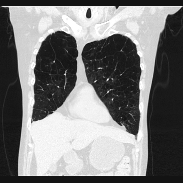 Centrilobular pulmonary emphysema (Radiopaedia 24495-24789 Coronal lung window 17).jpg