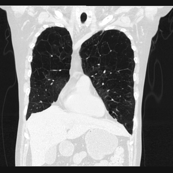 Centrilobular pulmonary emphysema (Radiopaedia 24495-24789 Coronal lung window 20).jpg