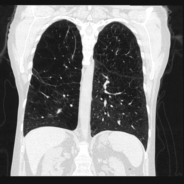 Centrilobular pulmonary emphysema (Radiopaedia 24495-24789 Coronal lung window 50).jpg