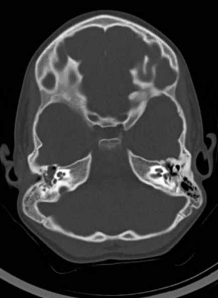 File:Cerebellar abscess (Radiopaedia 73727-84527 Axial bone window 25).jpg