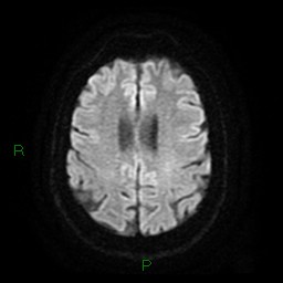 Cerebellar abscess (Radiopaedia 78135-90678 Axial DWI 21).jpg
