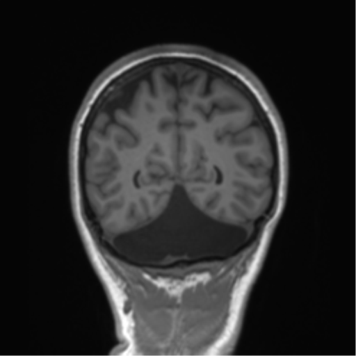 Cerebellar agenesis with hypoplastic pons (pontocerebellar hypoplasia) (Radiopaedia 57224-64138 Coronal T1 25).png