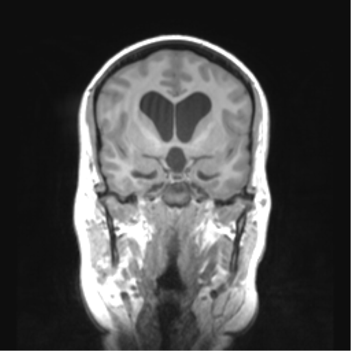 Cerebellar ependymoma complicated by post-operative subdural hematoma (Radiopaedia 83322-97736 Coronal T1 23).png
