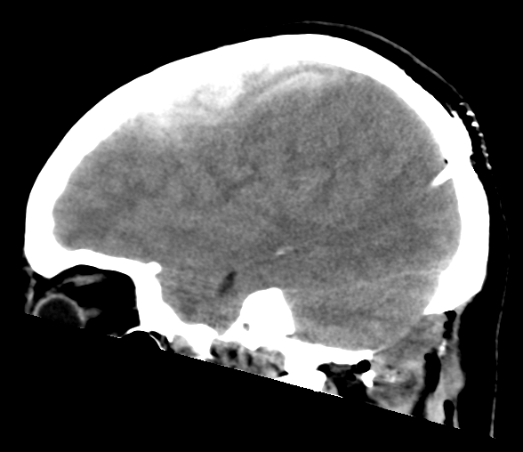 File:Cerebellar ependymoma complicated by post-operative subdural hematoma (Radiopaedia 83322-97737 C 10).png