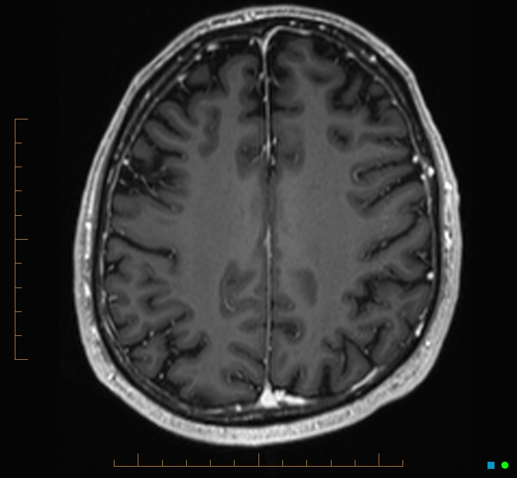 Cerebellar gangliocytoma (Radiopaedia 65377-74422 Axial T1 C+ 98).jpg