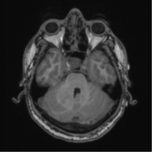 Cerebellar hemangioblastomas and pituitary adenoma (Radiopaedia 85490-101176 Axial T1 22).png