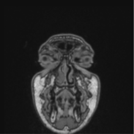 File:Cerebellar hemangioblastomas and pituitary adenoma (Radiopaedia 85490-101176 Coronal T1 88).png