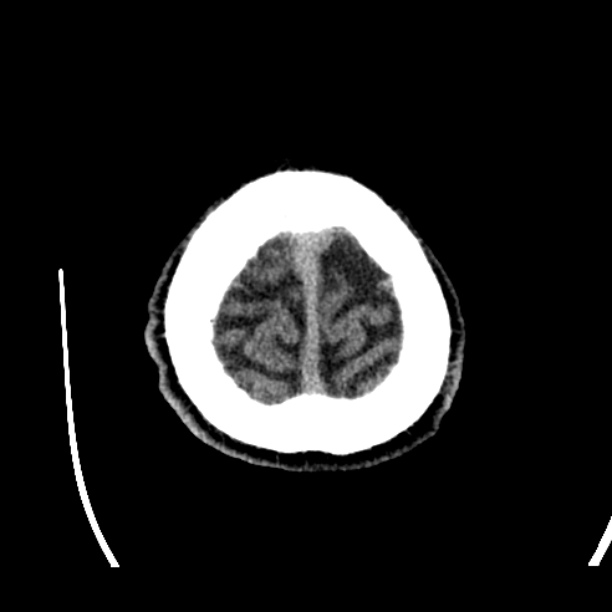 Cerebellar hemorrhage (Radiopaedia 27193-27359 Axial non-contrast 52).jpg