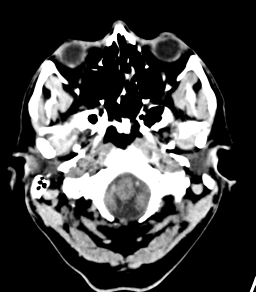File:Cerebellar hemorrhage (Radiopaedia 37000-38669 Axial non-contrast 6).png