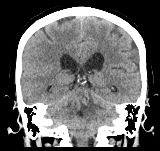 File:Cerebellar metastasis (Radiopaedia 54578-60812 Coronal non-contrast 36).png
