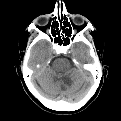 File:Cerebellar metastasis (cystic appearance) (Radiopaedia 41395-44258 Axial non-contrast 18).png