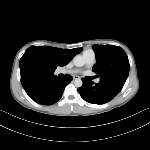File:Cerebellar metastasis - adenocarcinoma lung (Radiopaedia 63184-71717 Axial C+ delayed 34).png