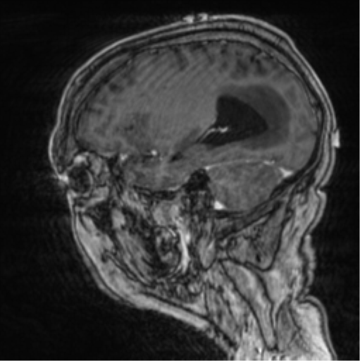 Cerebellar metastasis from lung adenocarcinoma (Radiopaedia 86690-102829 Sagittal T1 C+ 24).png