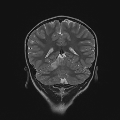 File:Cerebellar stroke (Radiopaedia 32202-33150 Coronal T2 22).png