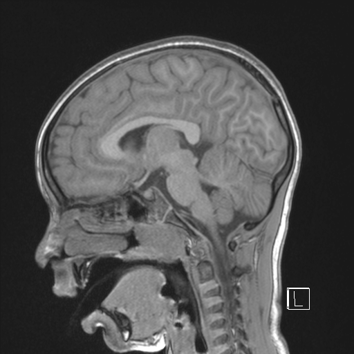Cerebellar stroke (Radiopaedia 32202-33150 Sagittal T1 C+ 28).png