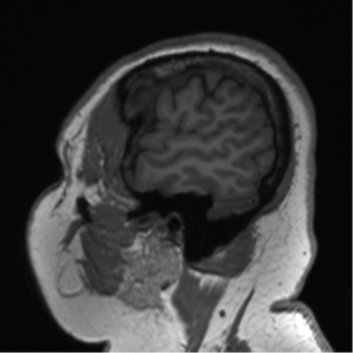 Cerebellopontine angle meningioma (Radiopaedia 48434-53348 Sagittal T1 17).png