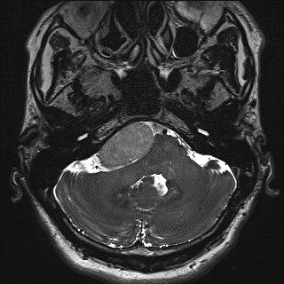 Cerebellopontine angle meningioma (Radiopaedia 72983-83680 Axial FIESTA 21).jpg