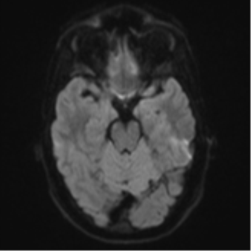 Cerebral abscess (Radiopaedia 60342-68009 Axial DWI 48).png