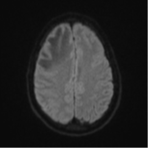 File:Cerebral abscess (Radiopaedia 60342-68009 Axial DWI 62).png