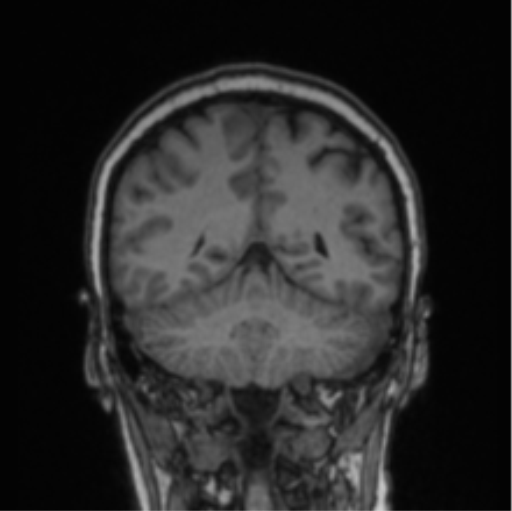 Cerebral abscess from pulmonary arteriovenous malformation (Radiopaedia 86275-102291 Coronal T1 30).png