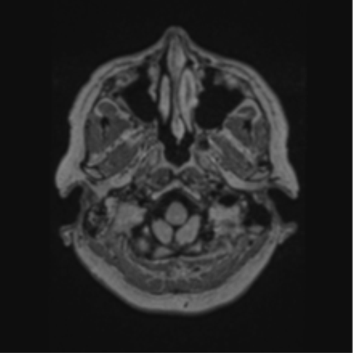 Cerebral abscess from pulmonary arteriovenous malformation (Radiopaedia 86275-102291 J 12).png