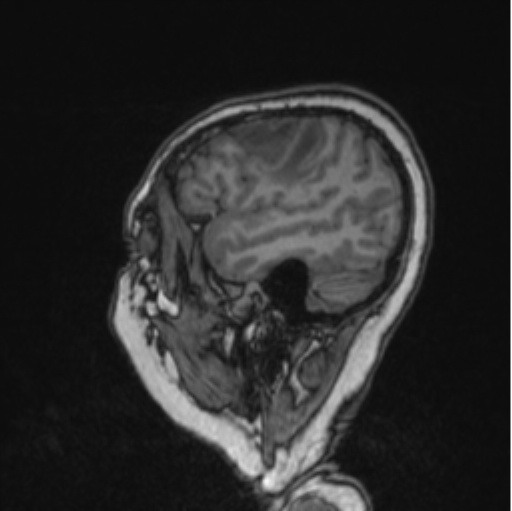 Cerebral abscess from pulmonary arteriovenous malformation (Radiopaedia 86275-102291 Sagittal T1 76).png