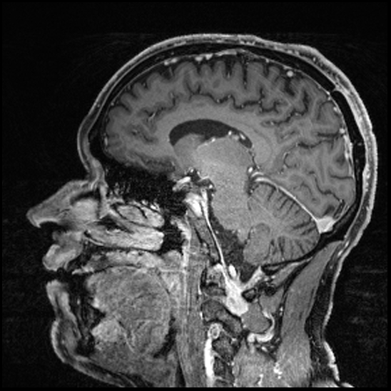 Cerebral abscess with ventriculitis (Radiopaedia 78965-91878 Sagittal T1 C+ 81).jpg