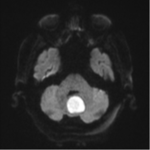 Cerebral abscesses- medically managed (Radiopaedia 45183-49179 Axial DWI 36).png