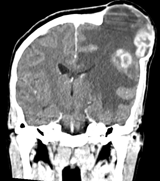 Cerebral abscesses (Radiopaedia 70458-80568 Coronal Contrast 36).jpg