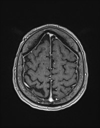 Cerebral amyloid angiopathy-related inflammation (Radiopaedia 58270-65377 Axial T1 C+ fat sat 122).jpg