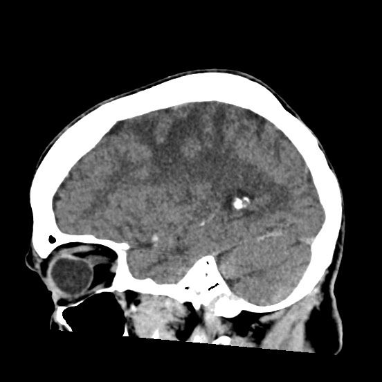 Cerebral amyloid angiopathy-related inflammation (Radiopaedia 74836-85848 C 19).jpg