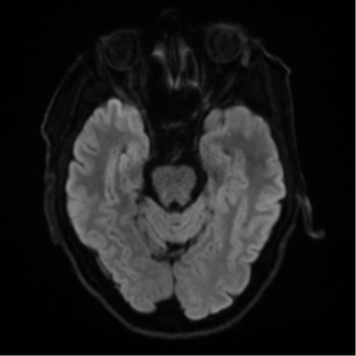 Cerebral amyloid angiopathy (Radiopaedia 46082-50433 Axial DWI 36).png