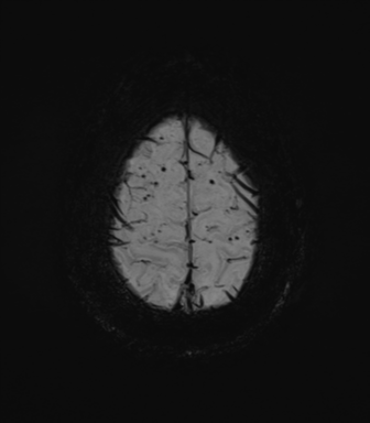 Cerebral amyloid angiopathy (Radiopaedia 46082-50433 Axial SWI MIP 71).png