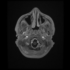 Cerebral and spinal tuberculosis (Radiopaedia 90489-107837 Axial T1 C+ 33).jpg
