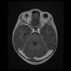 Cerebral and spinal tuberculosis (Radiopaedia 90489-107837 Axial T1 C+ 74).jpg